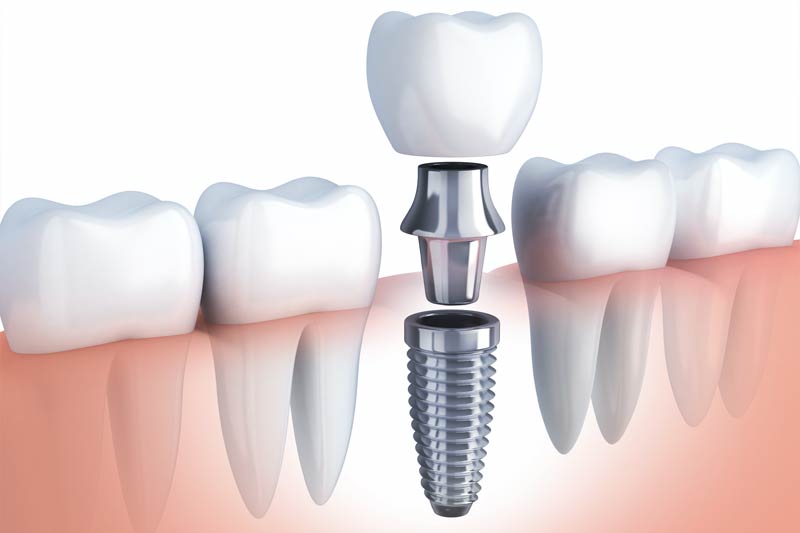Implants Dentist in Palos Hills