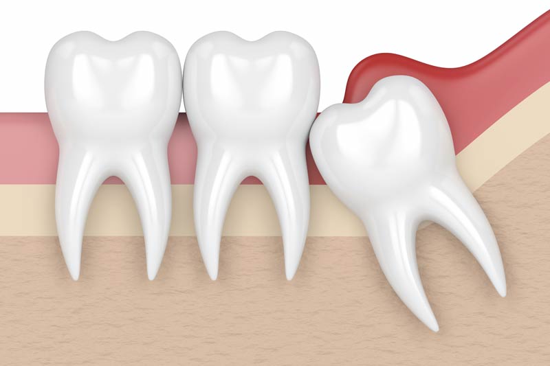 Wisdom Tooth Removal in Palos Hills